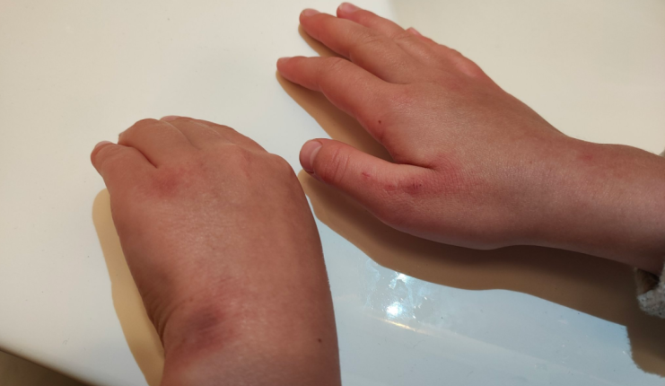 ręce córki poseł Siarkowskiej po tygodniu dezynfekcji w szkole/ fot. Twitter